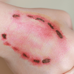 Different Levels of Dog Bites – What to Expect in Each Level?