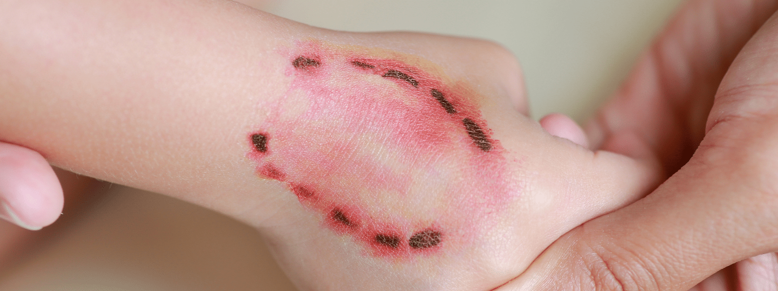 dog bite wounds