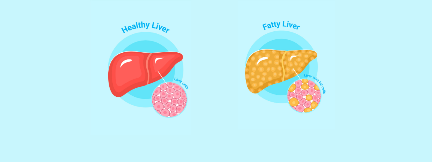 Fatty Liver Disease: Causes, Risk and Prevention