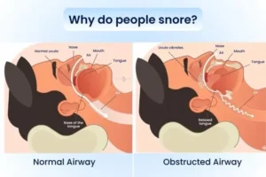  A graphic containing text “Why do people snore?” and in the middle a labelled design showing the snoring mechanism during sleep.