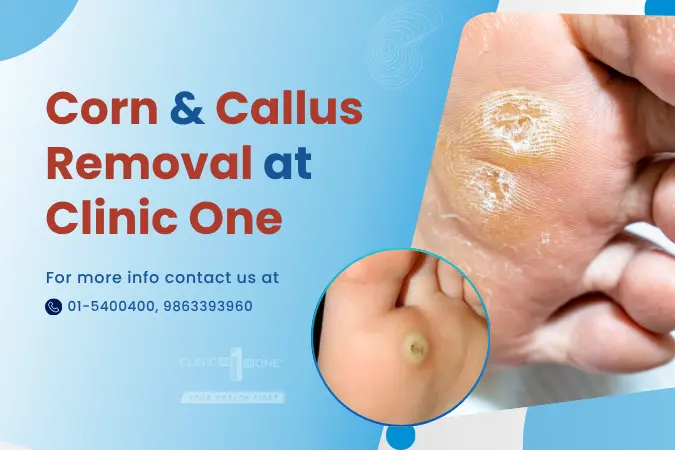 Corn & Callus Removal at Clinic One