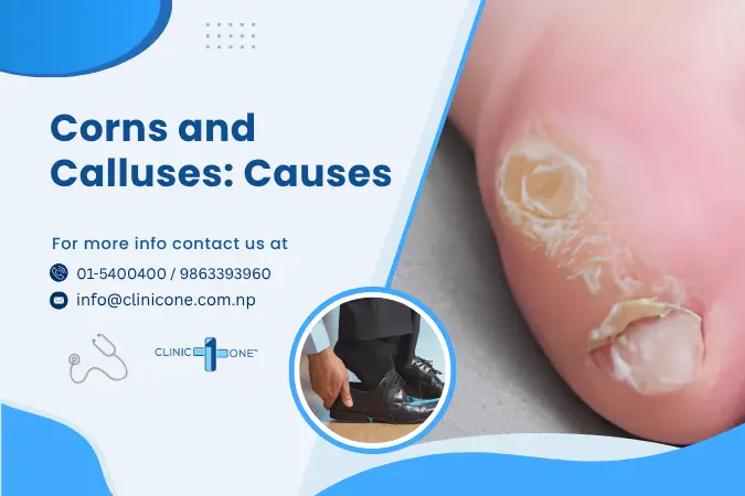Why Do I Have Corns and Calluses? Causes