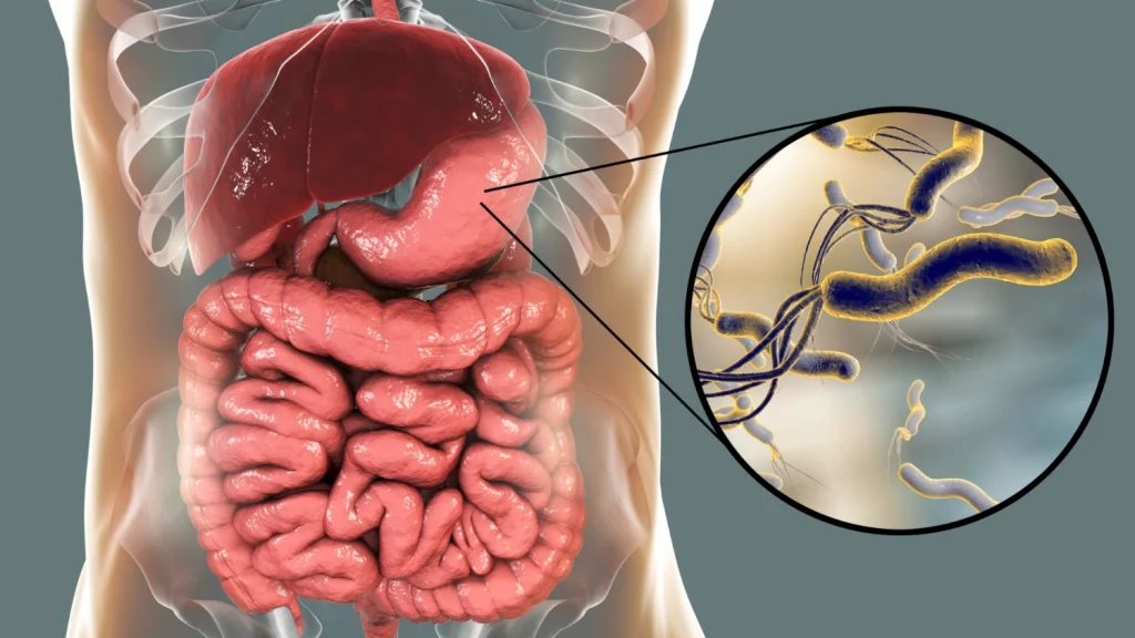 h pylori bacteria causing gastritis in nepal